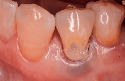 复合树脂微创美学修复——前牙的修复