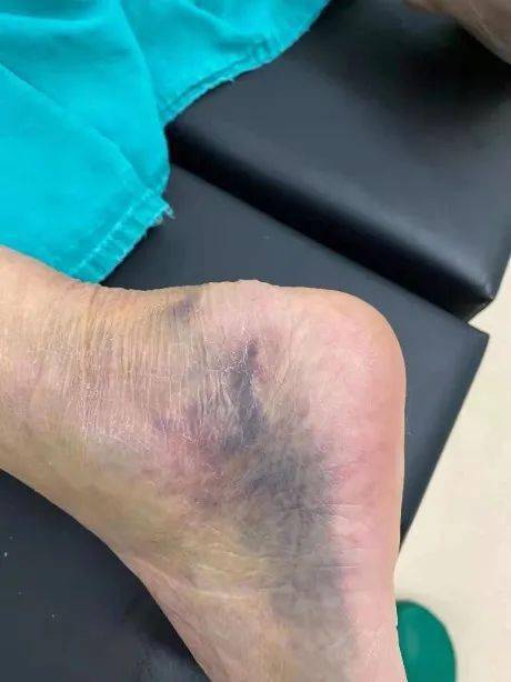 跟腱止点炎合并钙化断裂 有效止痛并顺利手术治疗年初六一大早,手术在