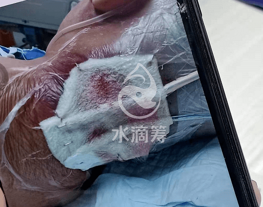 爱心接力永春一女子身患脓毒血症发帖盼伸援手