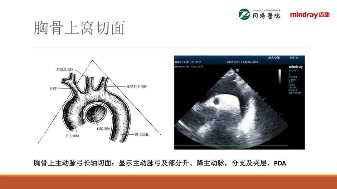 武汉同济医院麻醉科围术期经胸超声心动图tte