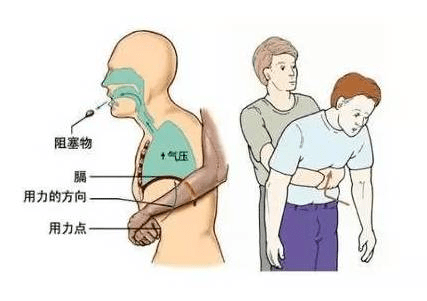 急救法海姆立克儿童视频 61817cfd5d8247d88b9d6bdc1274fb97.png