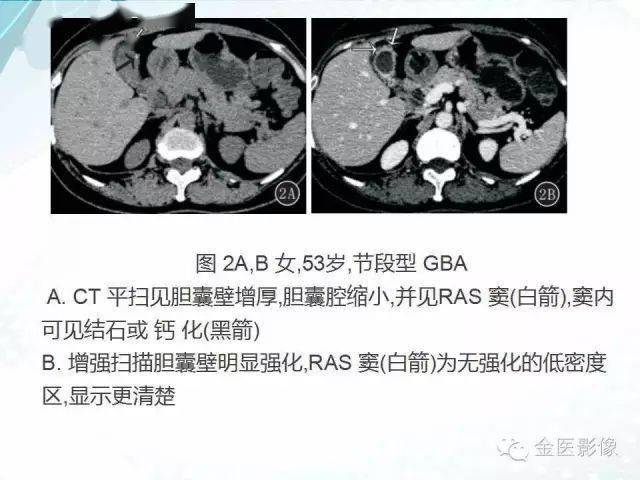 胆囊腺肌症影像表现及鉴别