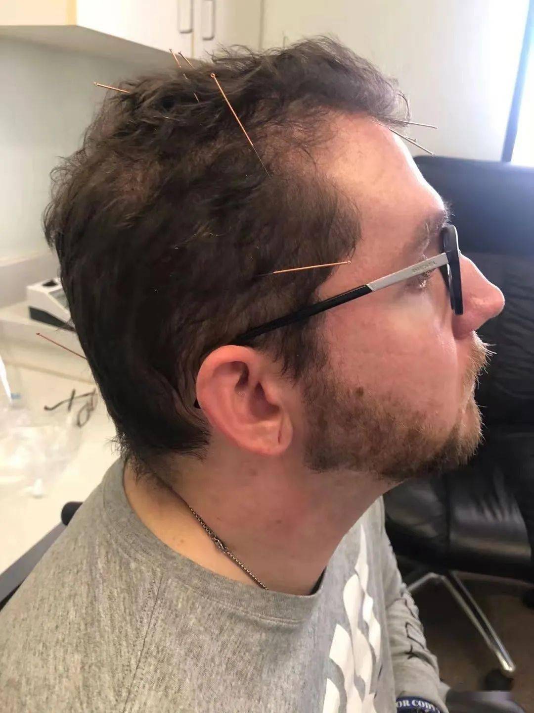 病案讨论郝吉顺头针