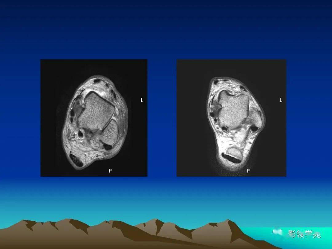 跟腱断裂mri图片