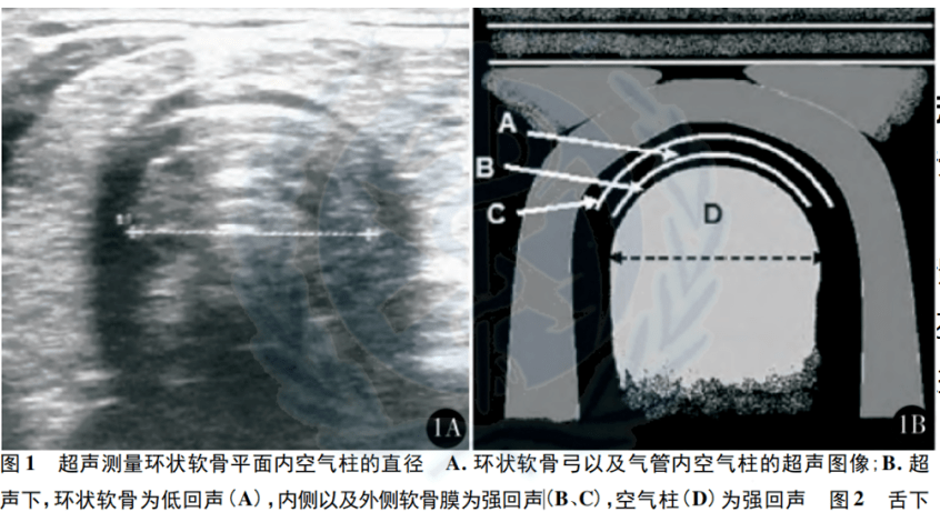 正常值≥9cm3,甲颏间距:头后仰至最大时,颏突至甲状软骨切迹间的距离