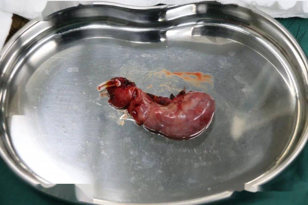 胃穿孔手术后图片图片