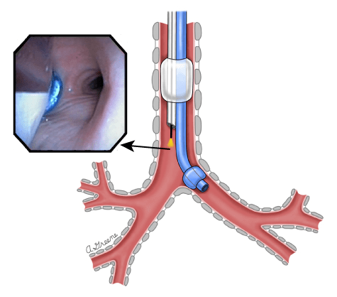 左双腔支气管导管图片图片