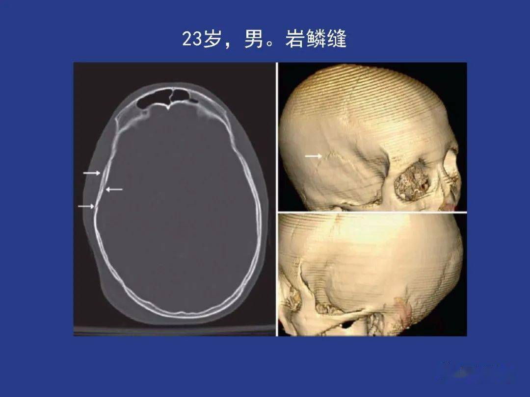 顱骨正常及常見變異的影像學表現