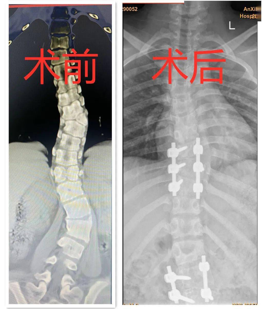 技术突破安溪县医院开展首例重度脊柱侧弯矫形手术