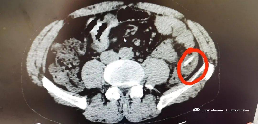 邵东灵官殿一男子吃瓜果致肠穿孔啥情况