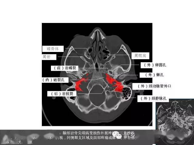 颅底ct断层解剖骨窗图片