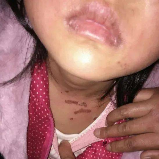 5 岁小女孩扁桃体异物就诊,口唇暗沉,左耳脱皮无出血,面部存在溃破