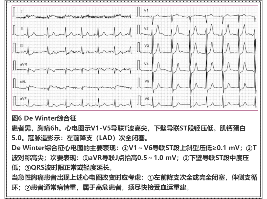 心梗不典型心電圖18個圖例練就火眼金睛