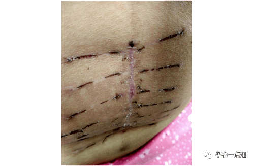 子宫切除手术伤口图片图片