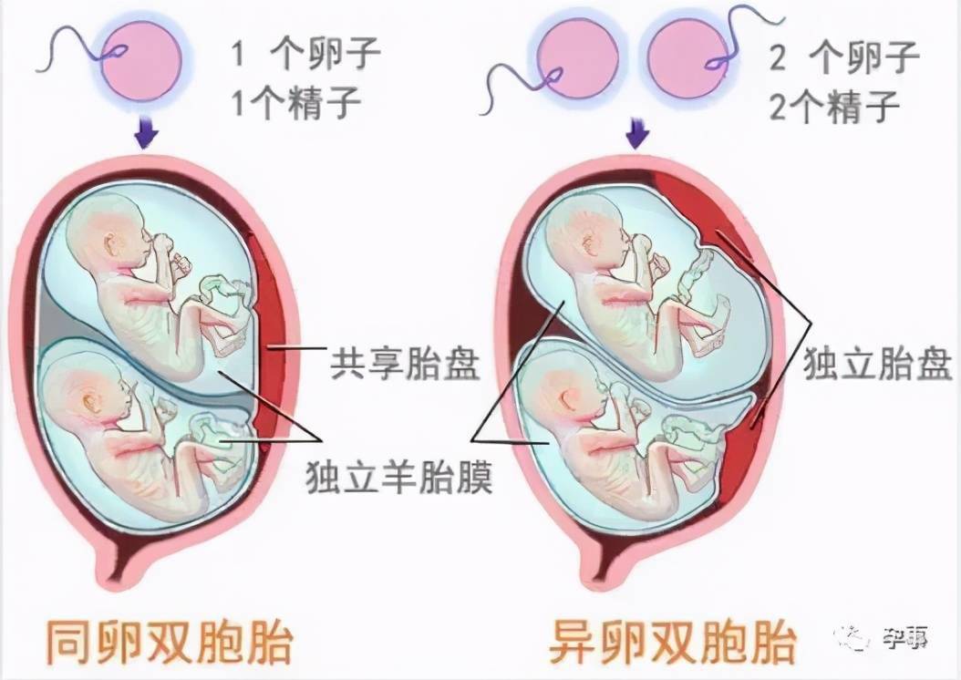 ②异卵双胞胎:两个卵被两个精子同时受精,产生异卵双胞胎,胎儿有自己