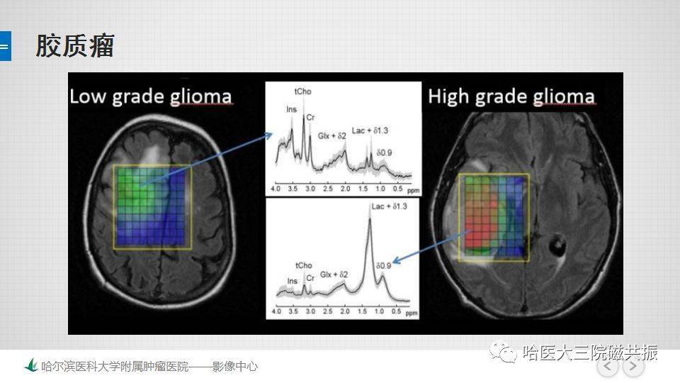 磁共振波谱成像mrs的原理及临床应用