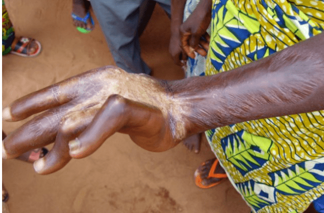 buruli ulcer是一种由溃疡分枝杆菌引起的溃疡性皮肤病,主要殃及皮肤