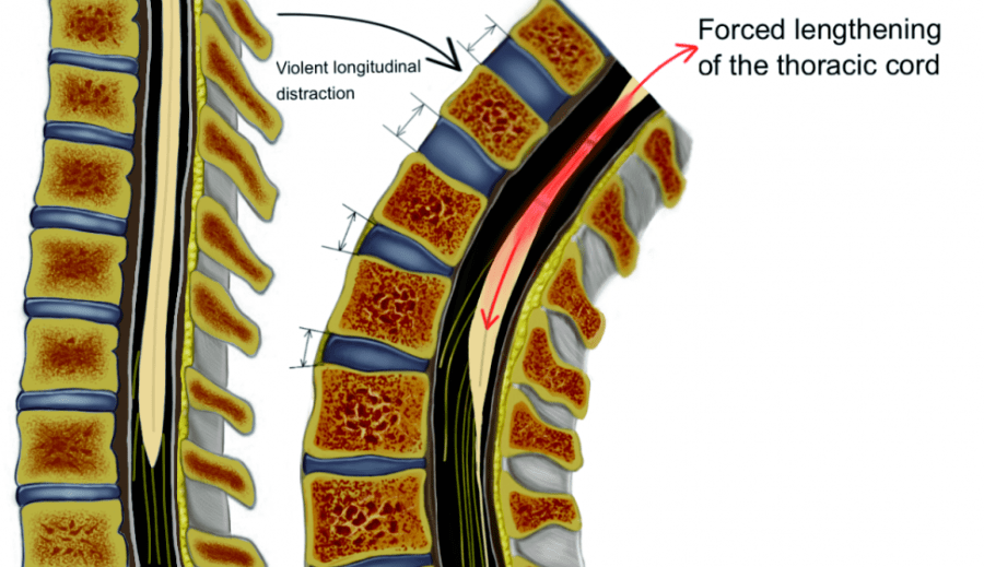 脊髓损伤神经平面图片