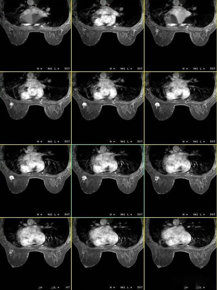 乳腺癌磁共振图片图片