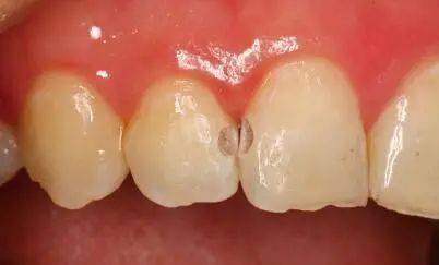 邻面龋很容易导致牙齿嵌塞,残留的食物在细菌的作用下会释放更多有害