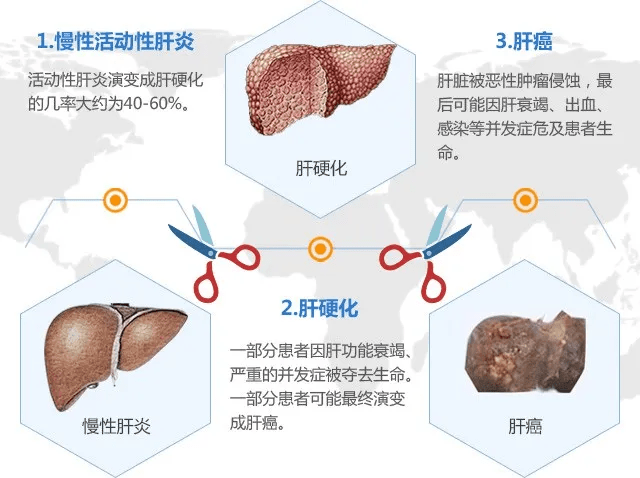 肝癌是什么原因引起的图片