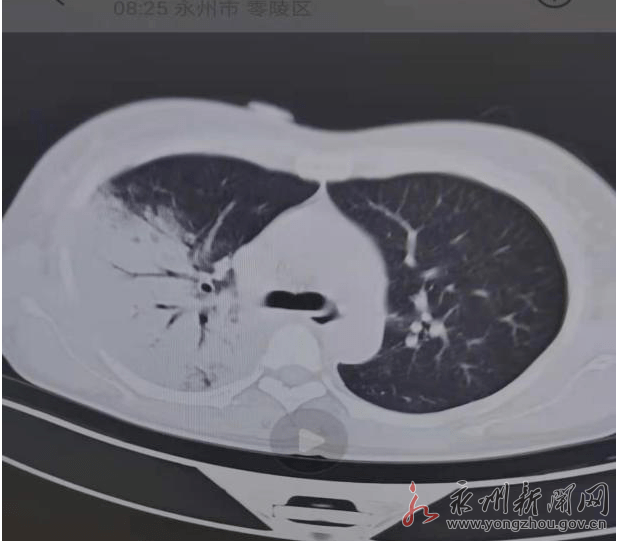 永州市第四人民医院治愈一例鹦鹉热衣原体感染患者