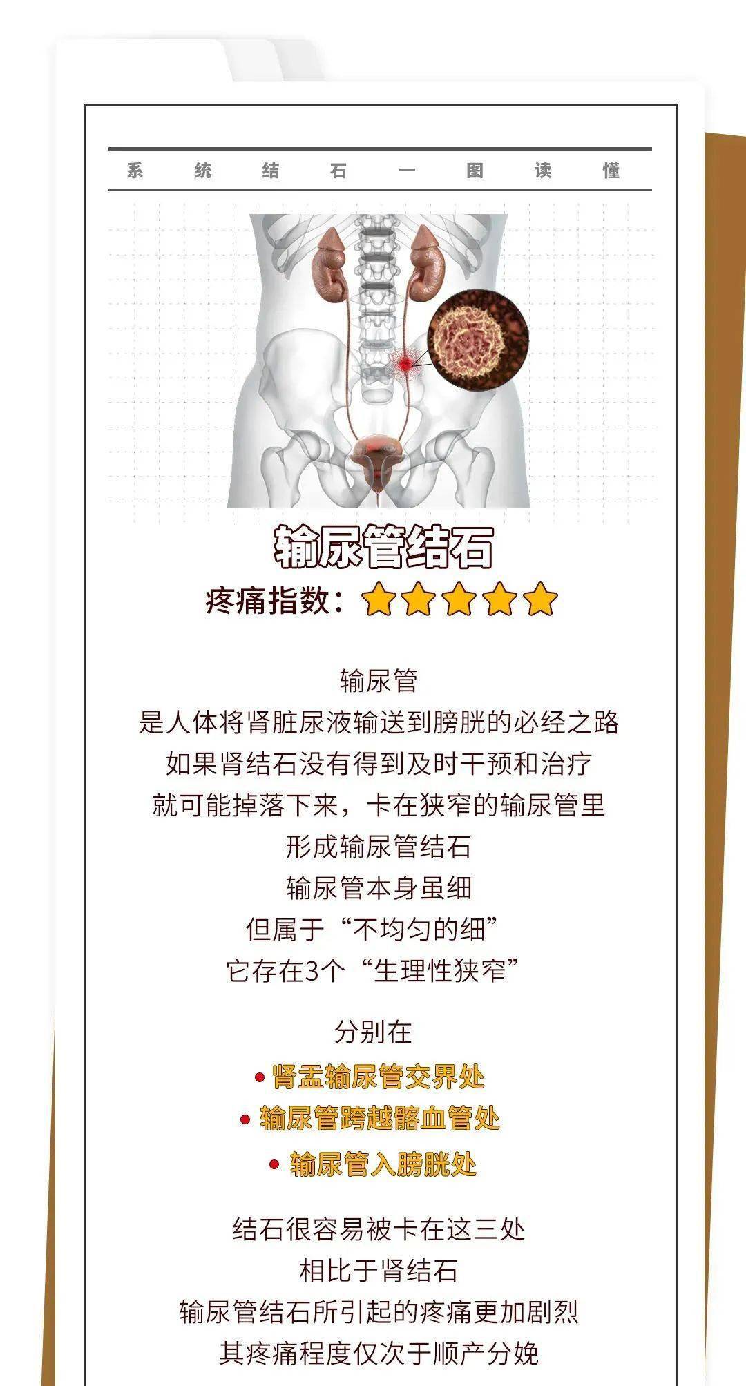 有一种泌尿系统结石,不痛比痛更可怕!