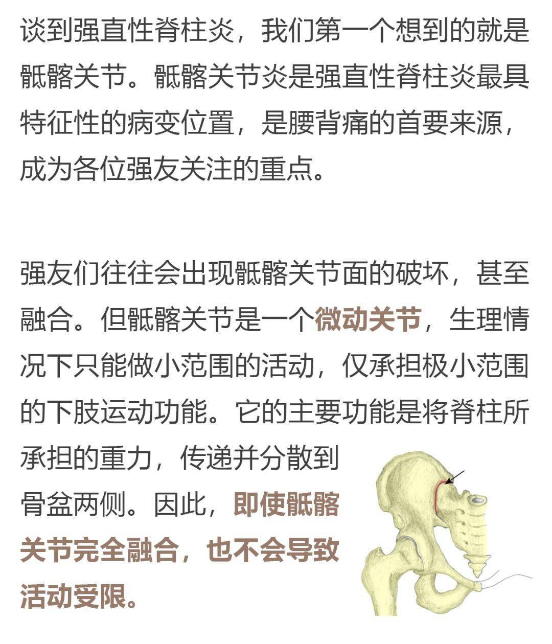 【中医·强直性脊柱炎】强直性脊柱炎患者的髋关节为什么这么重要?