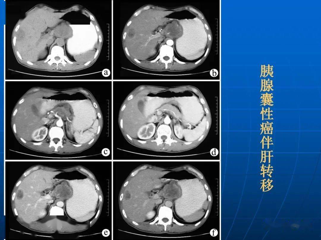 非功能性胰島細胞瘤術後復發