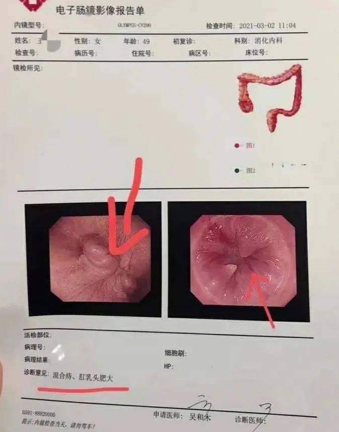 肠镜检查 痔疮图片