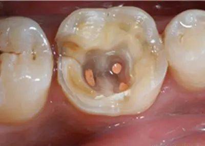 為什麼有時牙齒表面只有一個小洞卻需要根管治療
