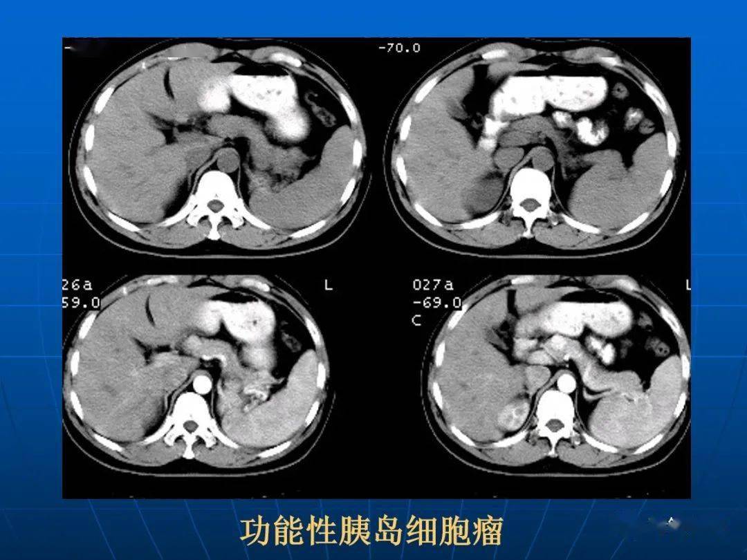 9種胰腺常見疾病的ct診斷_十二指腸