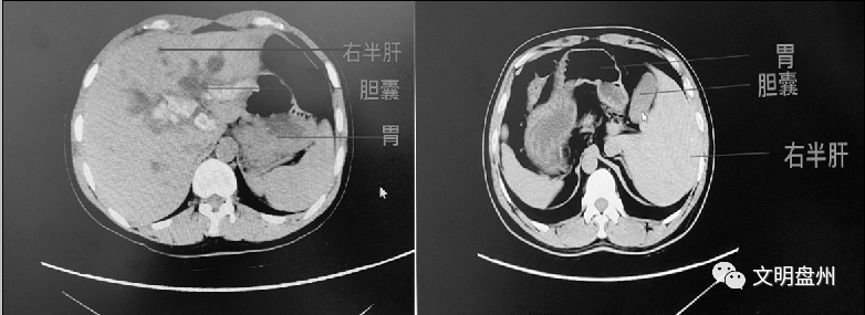 文明盤州十萬分之一盤州一男子內臟位置全長反手術麻煩了