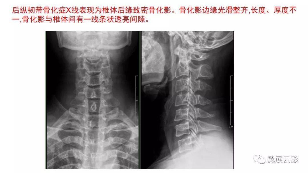 颈椎后纵韧带骨化症opllx线诊断