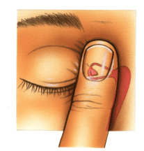 阻塞泪管——将手指按在眼角和鼻根之间会暂时关闭泪管系统,有助幼铑