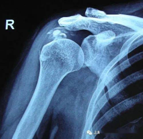 肩周炎x线平片报告图片
