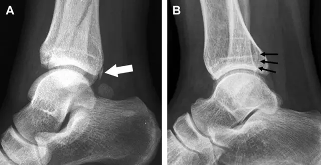 易漏诊的7 种踝部骨折 箭头