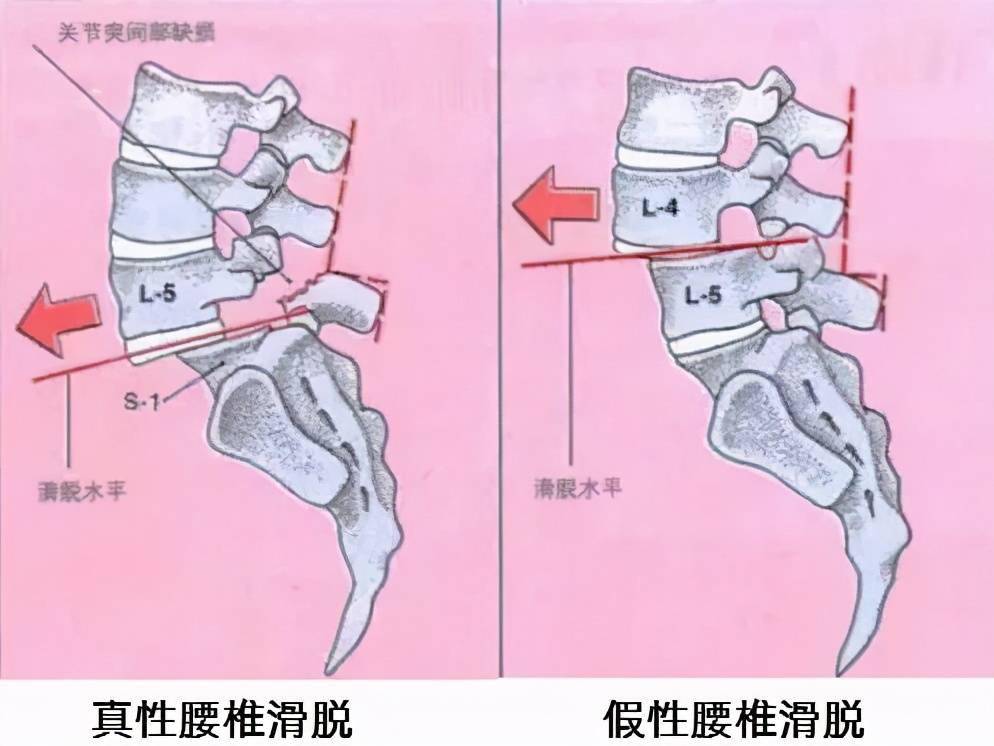 第五腰椎滑脱图片