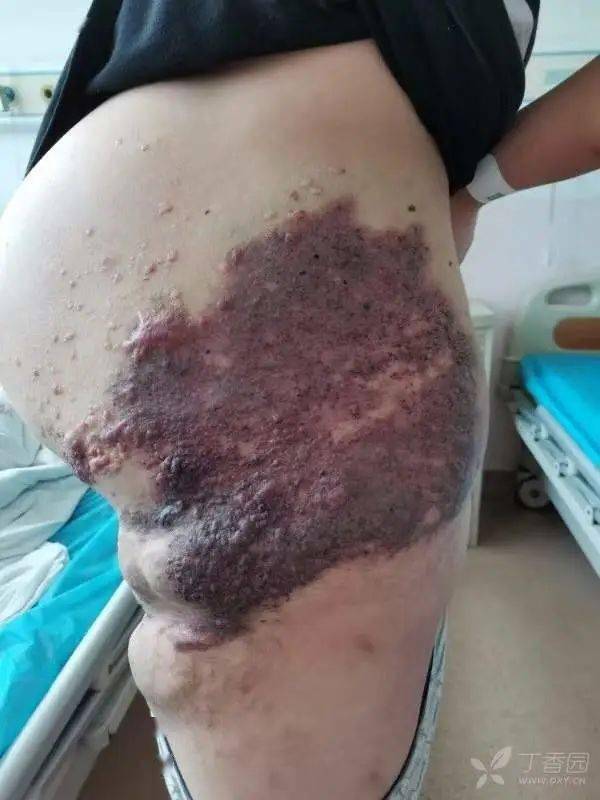 19 岁孕妇左腰部巨大血管瘤,隆起并发紫,下肢严重变形
