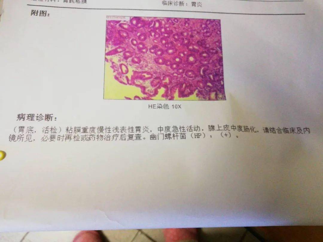 答疑解惑丨做胃腸鏡檢查時為什麼醫生會建議取樣活檢