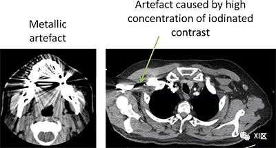 金属伪影/高密度异物伪影左侧为杯状伪影,右侧为校正后图像由于现代