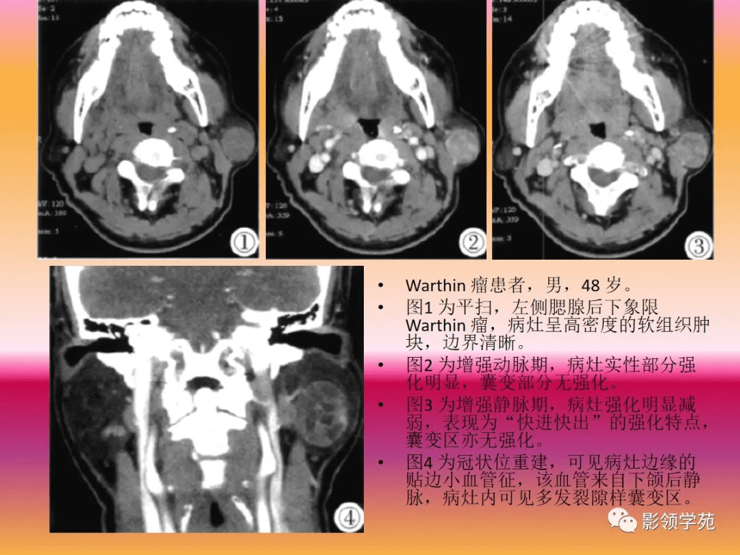 腮腺解剖结构图CT图片
