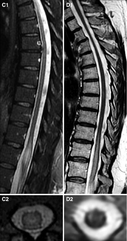 stroke:鉴别脊髓梗死和急性脊髓炎有好办法了