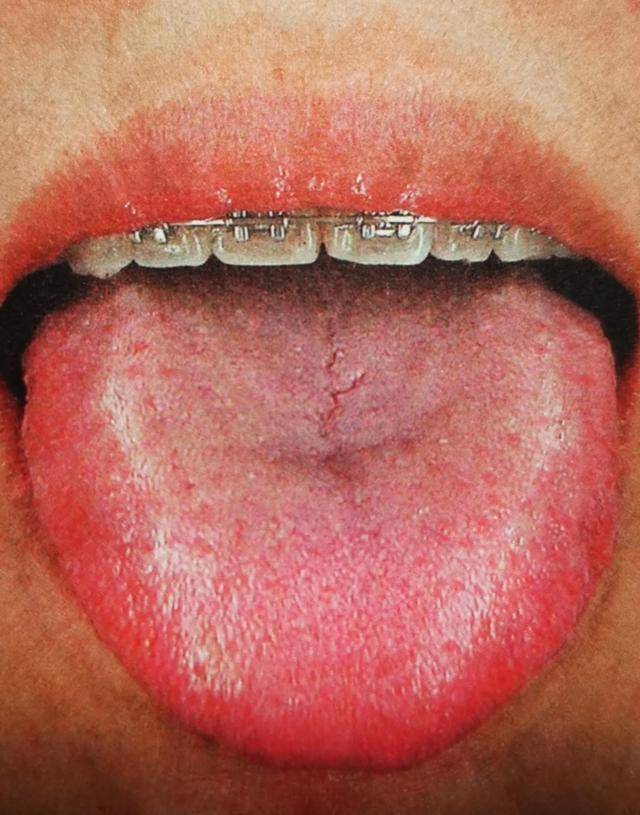 舌头圆圆胖胖的,有一点齿痕,并且在舌头两侧出现两条唾液线