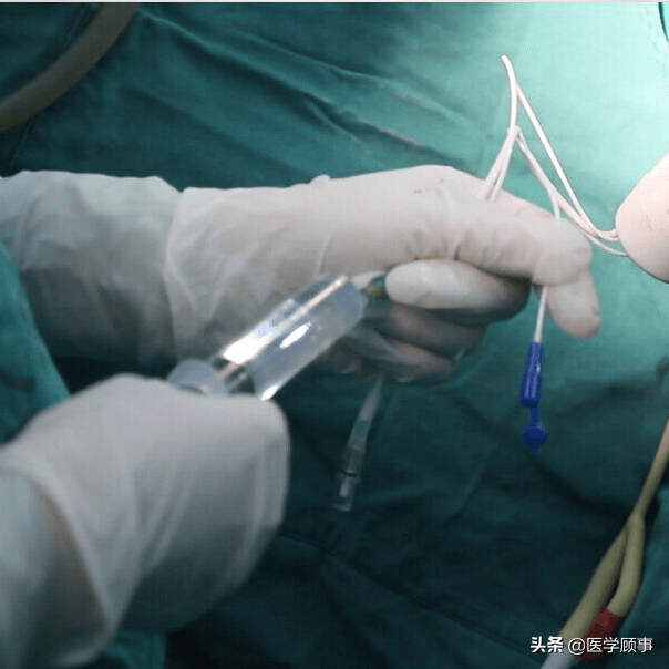 如做腹腔镜子宫切除手术,子宫不大的