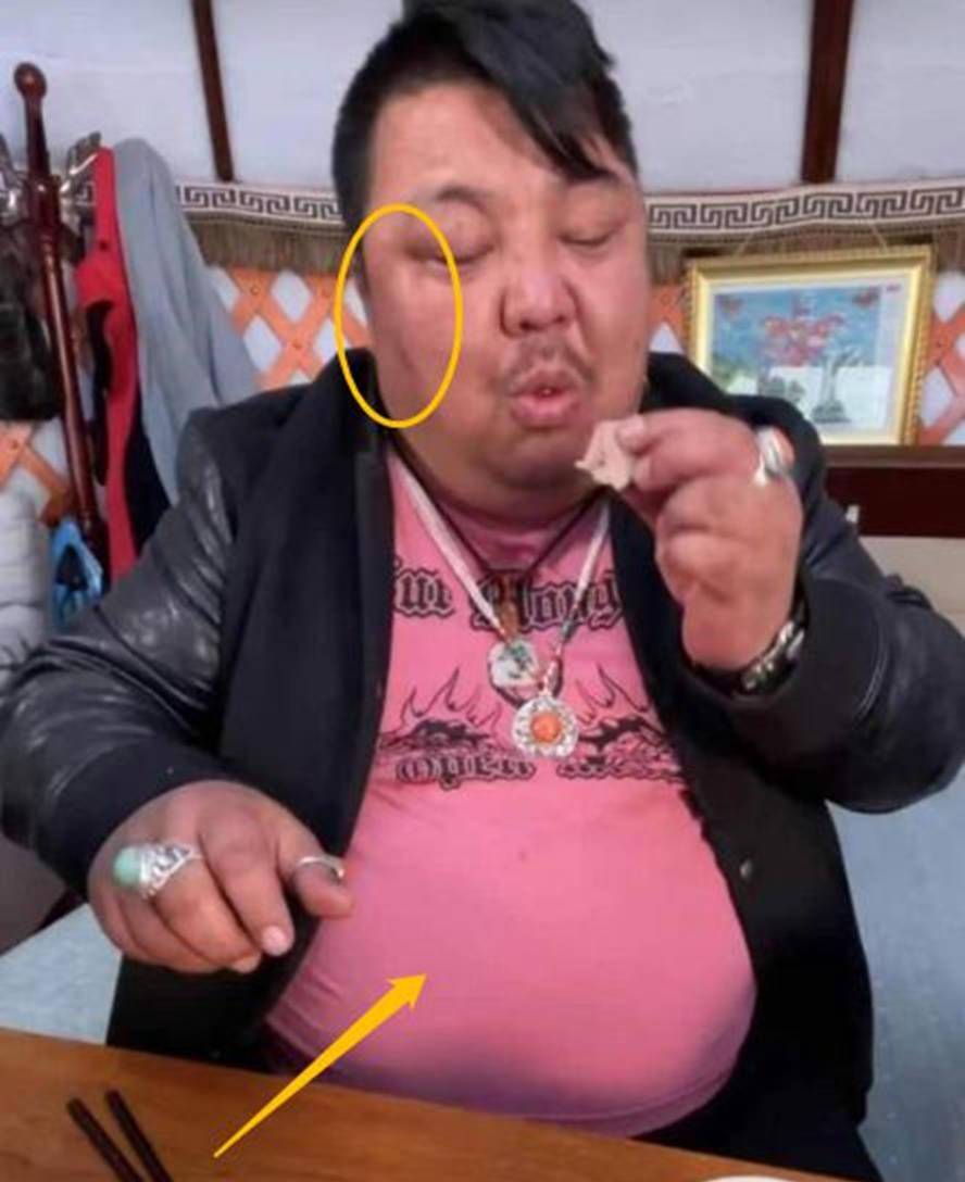 泡泡龙式悲剧再次上演千万网红脸上现黑斑昏睡不醒求救无人理