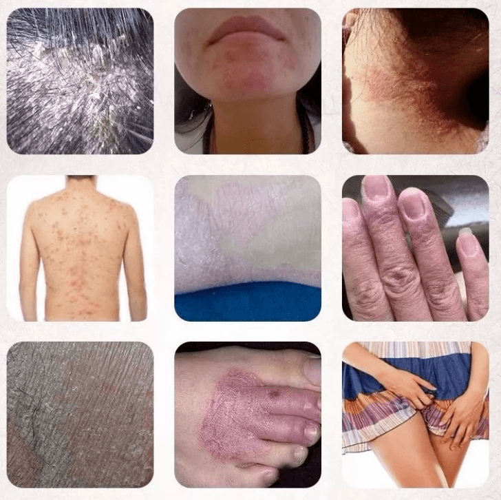 皮炎湿疹瘙痒忍无可忍不需要别的只需轻轻一抹这点瘙痒去无踪