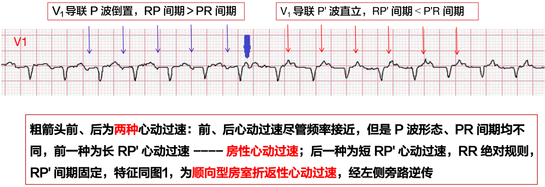 一張心電圖多種心動過速如何分析同濟專欄