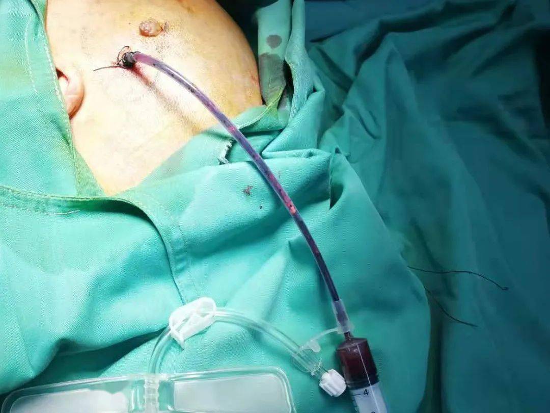 任泽区人民医院 成功开展一例微创穿刺抽吸血肿引流术