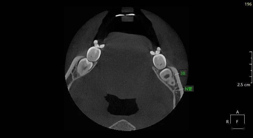 ct示:48近中阻生,双根,根尖紧邻下颌神经管上壁,38埋伏阻生,双根,根尖